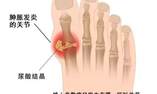 脐肉芽肿会自己好吗-宝宝脐肉芽肿挂什么科网 - 为你提供42天的宝宝脐肉芽肿什么时候带去治疗最好、婴儿脐肉芽肿图片大全